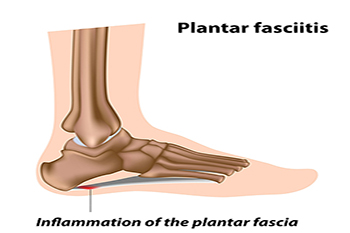 PLANTAR FASCIITIS – TREATMENT OPTIONS AND THE ROLE OF STEM CELL THERAPY